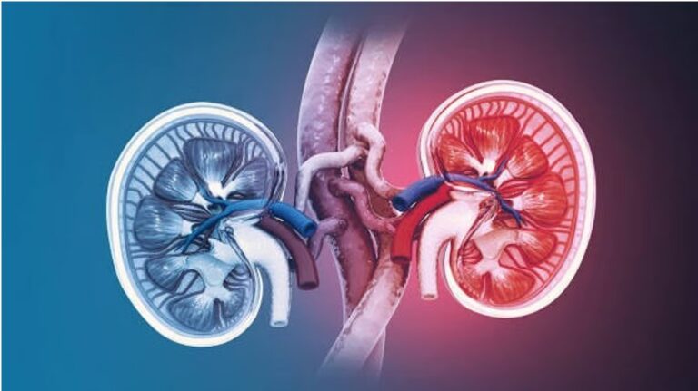 High temperatures directly linked to kidney stones
